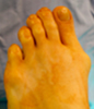 Conroe Corrective Bunion Surgery