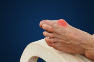 What Is a Bunion?